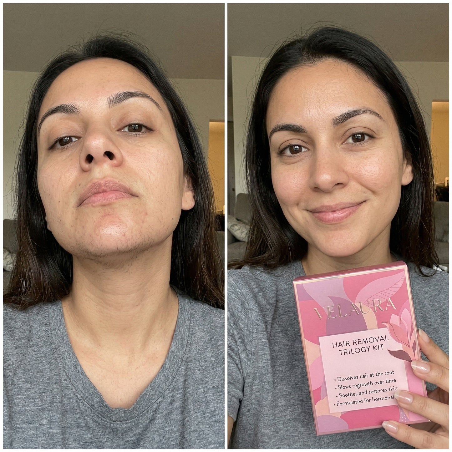 Velaura Hair Removal Trilogy Kit — For Hormonal & PCOS Facial Hair