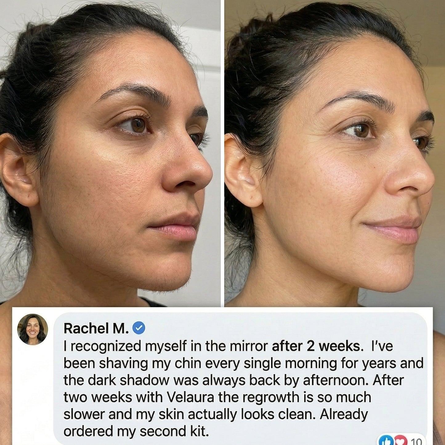 Velaura Hair Removal Trilogy Kit — For Hormonal & PCOS Facial Hair